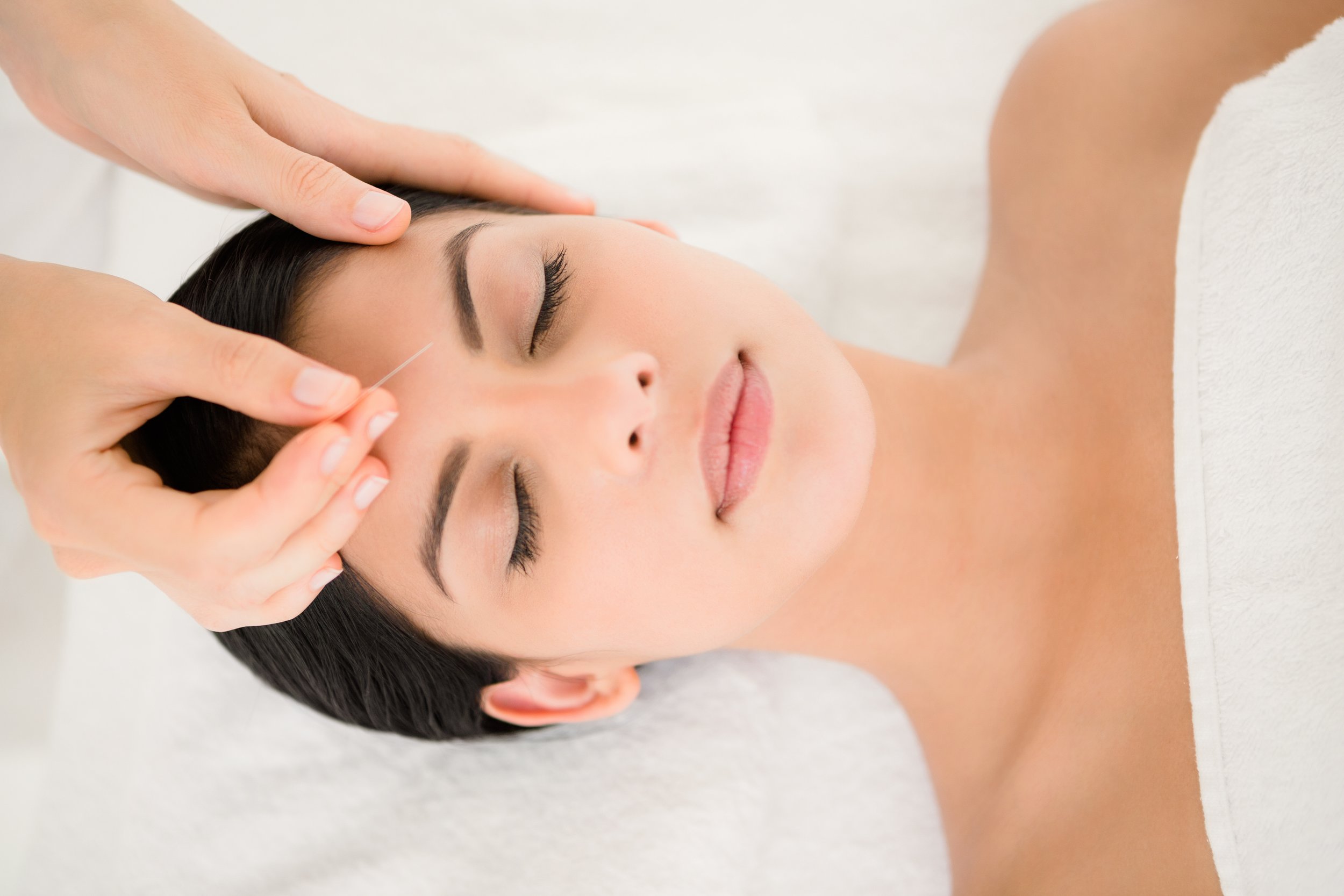 Acupuncture Acupuncture